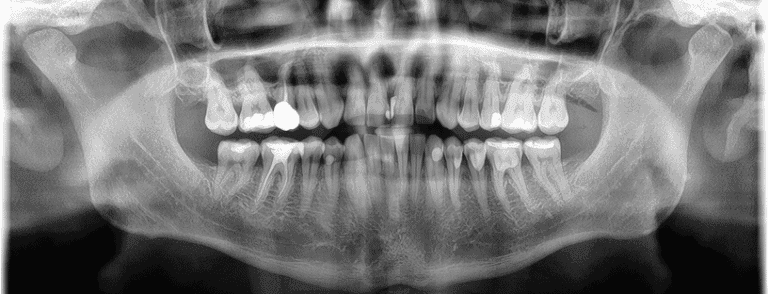 Pantomogram uzębienia z widocznymi wypełnieniami zębów