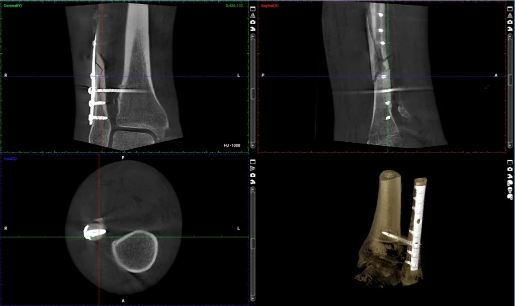 Przekroje tomografii podudzia ze śrubą stabilizującą i rekonstrukcją 3D