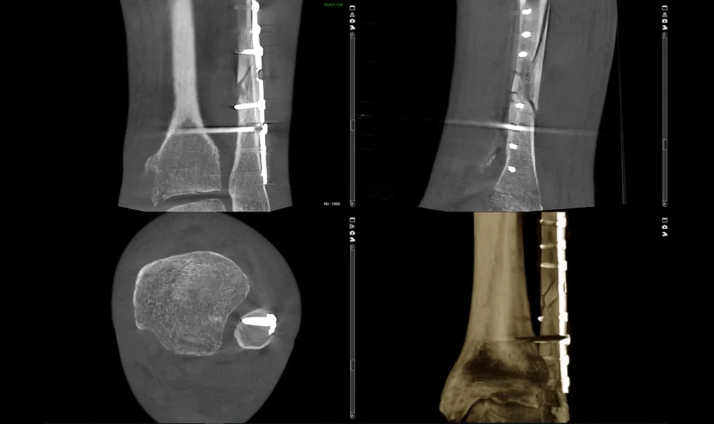 Przekroje tomografii kości piszczelowej ze śrubą i rekonstrukcją 3D