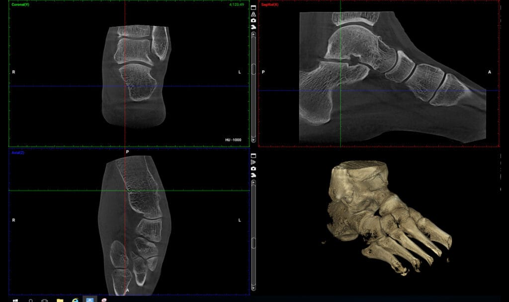Przekroje tomografii stopy z trójwymiarową rekonstrukcją kości