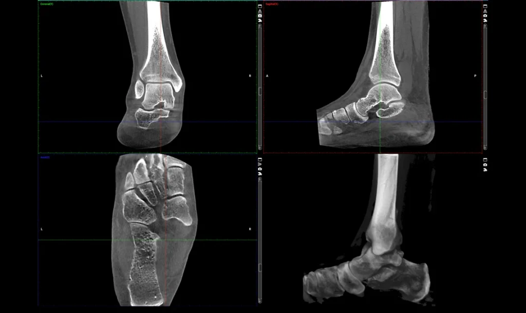 Przekroje tomografii stawu skokowego i kości stopy