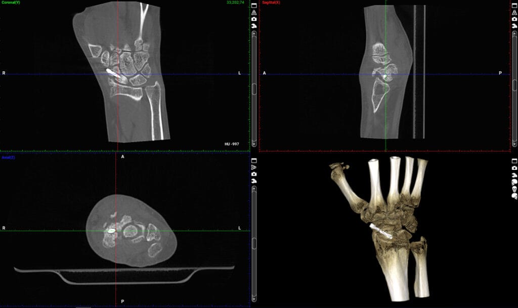 Przekroje tomografii nadgarstka z trójwymiarową rekonstrukcją dłoni
