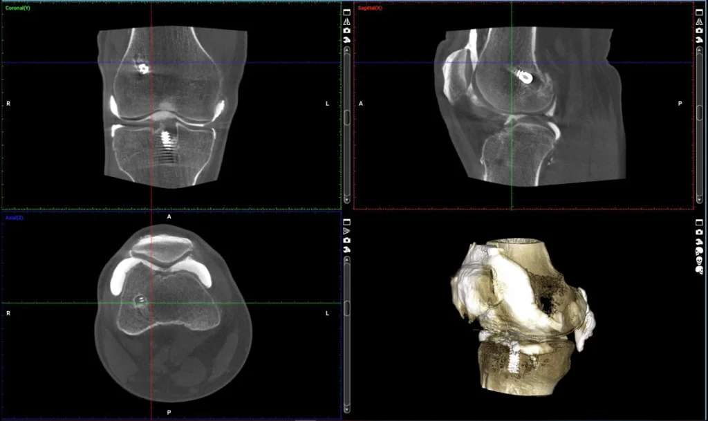 Przekroje tomografii stawu kolanowego z rekonstrukcją 3D