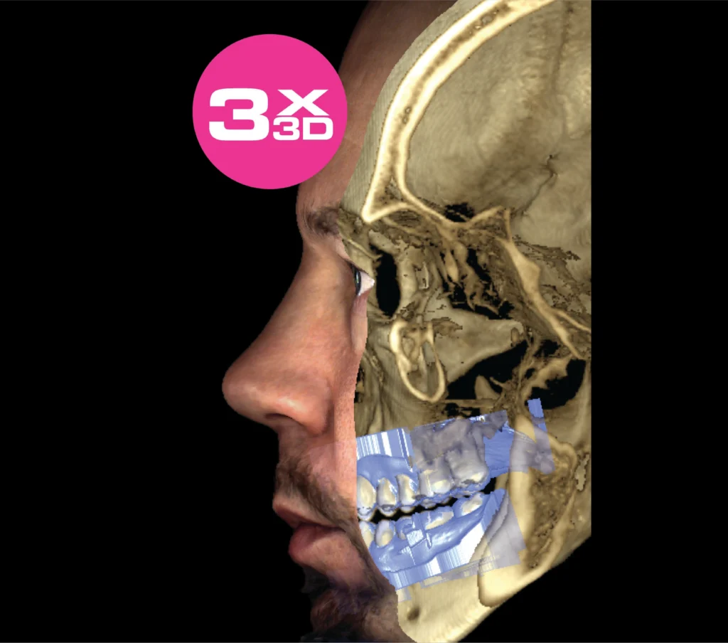 Skan 3D czaszki i uzębienia nałożony na profil twarzy pacjentki