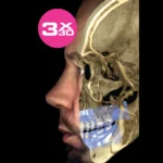 Skan 3D czaszki i uzębienia nałożony na profil twarzy pacjentki